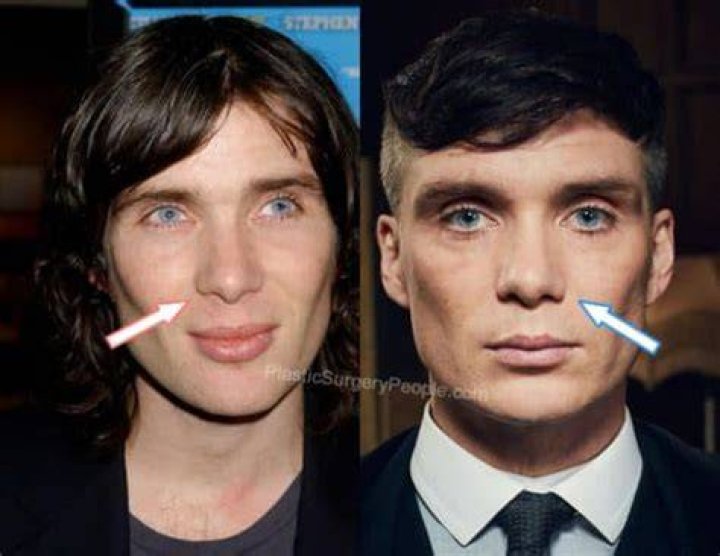 Cillian Murphy Nose | Did He Underwent Surgery | Before And After Pics