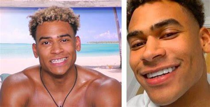 Marco Love Island Teeth | Does He Have Veneers On