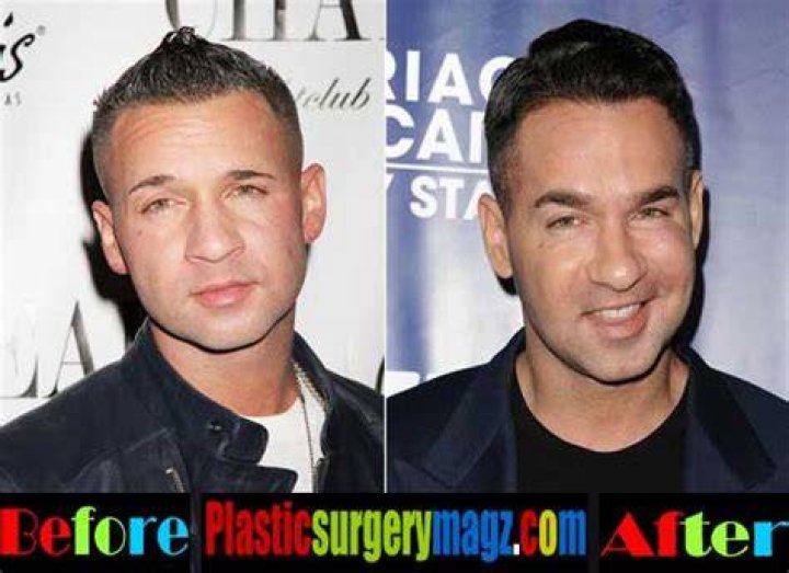 Mike The Situation Before And After Photos | Plastic Surgery Transformation